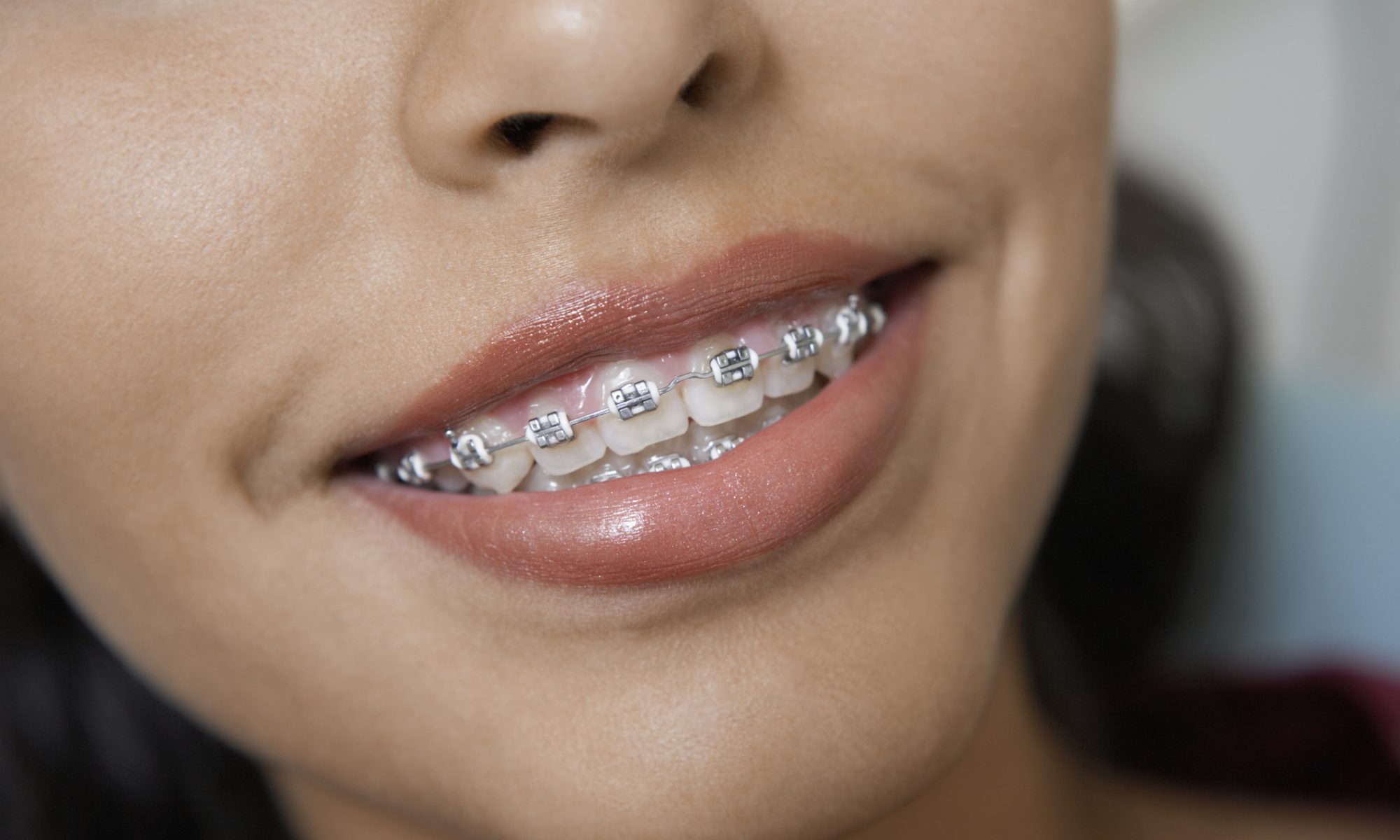 woman with braces