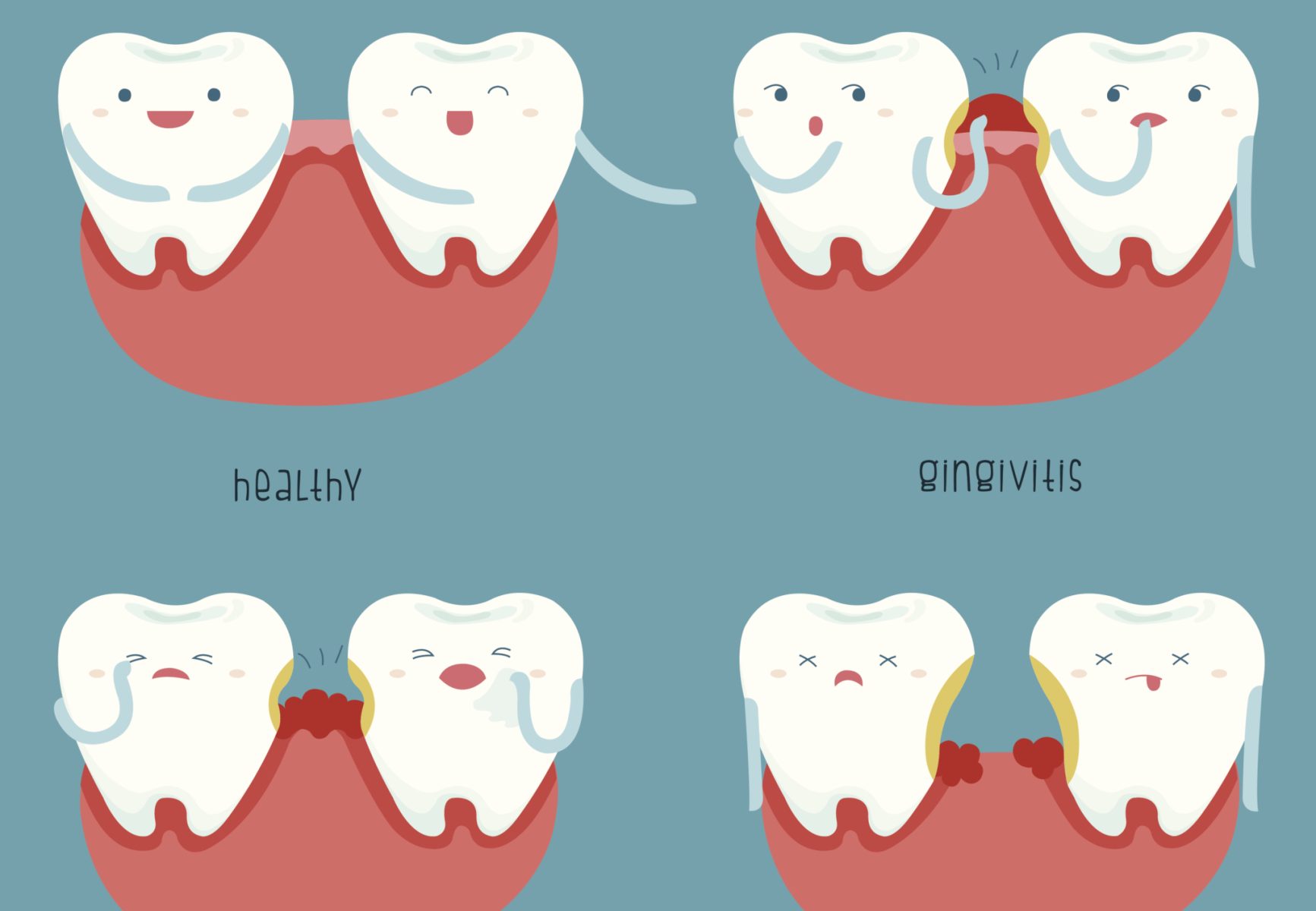 graphic of the stages of periodontal disease